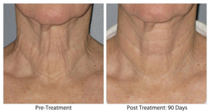 Female neck, before and 90 days after Ultherapy treatment, front view