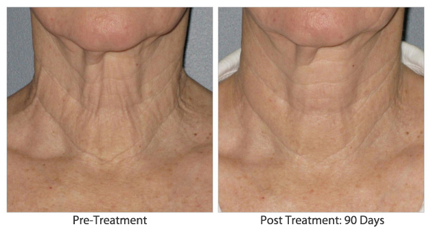 Ulthera Skin Tightening Advanced Dermatology Blog Dermatologists In
