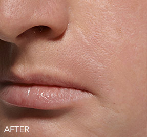 Female face, after Facial Filler treatment, oblique view