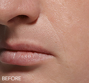 Female face, before Facial Filler treatment, oblique view