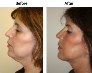 Female face, before and after ThermiRF Skin Tightening treatment, side view