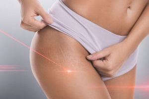 Dr. Smart on Treating Stretch Marks