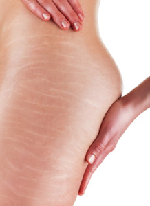 Stretch Marks And Cellulite