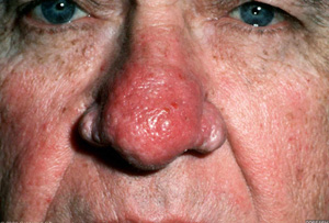 Kvalifikation Klemme etisk Rhinophyma: Tips for Dealing with a Large, Red Nose | Doctors in the News:  Advanced Dermatology