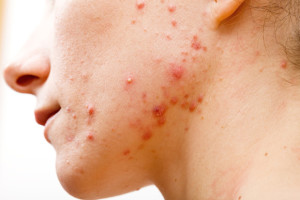 Accutane is effective in 85% of patients.