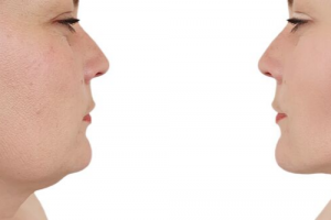 New Aesthetic Treatment KYBELLA Eliminates Double Chin