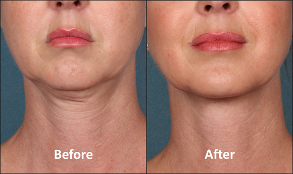 Female chin, before and after kybella treatment, front view, patient 1
