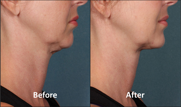 Female chin, before and after kybella treatment, side view, patient 2