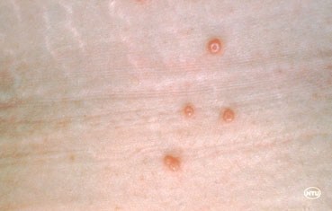 Molluscum contagiosum is a common skin disesase that causes bumps on the skin.