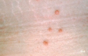 https://www.advanceddermatologypc.com/wp-content/uploads/2015/07/molluscum-contagiosum-skin-bumps.jpg