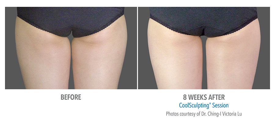 Female thigh, before and after Coolsculpting (back view, Inner and Outer Thighs) patient 1
