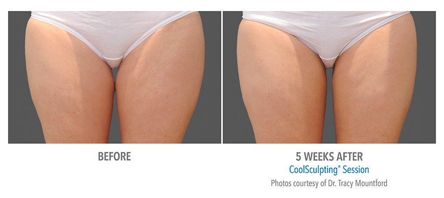 Female thigh, before and 5 weeks after Coolsculpting (front view, Inner and Outer Thighs) patient 2