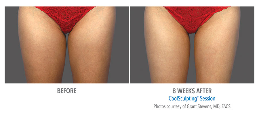 Female thigh, before and 8 weeks after Coolsculpting (front view, Inner and Outer Thighs) patient 2