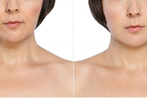 The Facts on Kybella