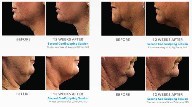 Patients necks, before and 12 weeks after Coolsculpting sessions, side view