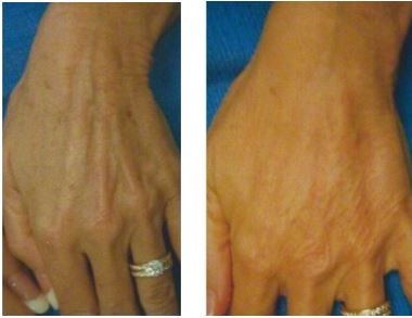 Female hand, before and after treatment, patient 1