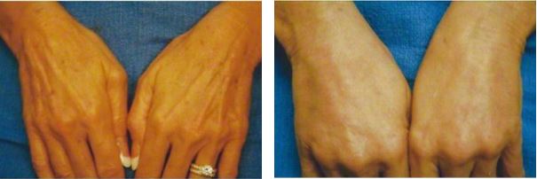 Female hands, before and after treatment, patient 1