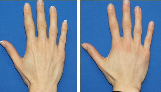 Female hand, before and after treatment, patient 2