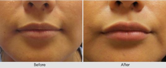 Female lips, before and after Restylane treatment, front view