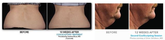 CoolSculpting before and after photo