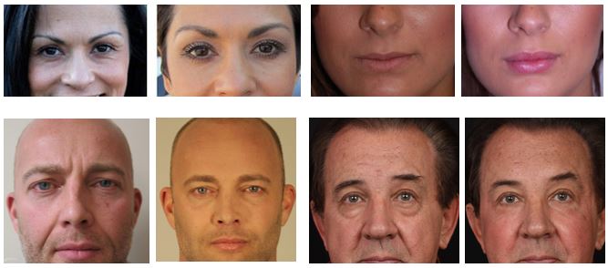 Females and males faces, before and after Dermal Fillers treatment, front view