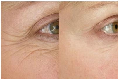 Woman's face, before and after ThermiSmooth treatment, under eye area, side view