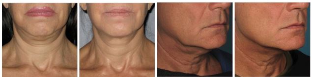 Females and males necks, before and after Ultherapy treatment, front view