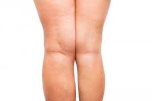 Product Spotlight: Thermage