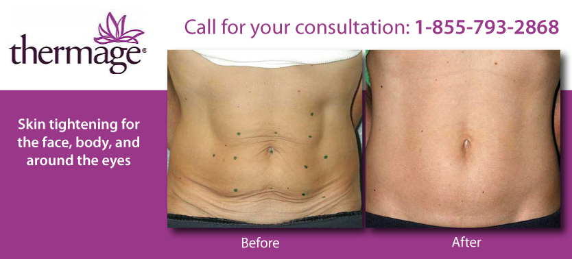Call for your consultation: 1-855-793-2868 - Female stomach, before and after thermage treatment