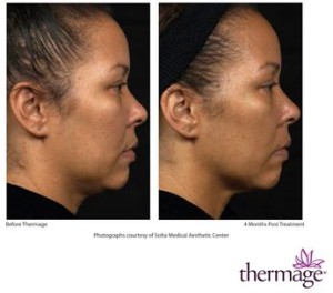 Female face, before and after Thermage treatment, side view, patient 2