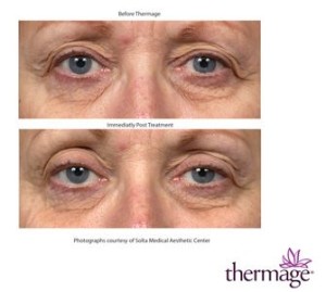 Patient eyes, before and after Thermage treatment, side view, patient 1