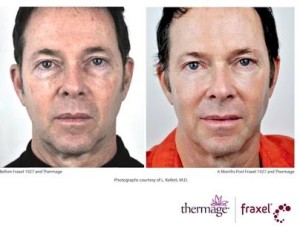 Male face, before and after Thermage treatment, side view, patient 4