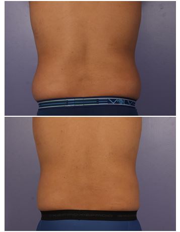 Male back, before and after CoolSculpting treatment, patient 1