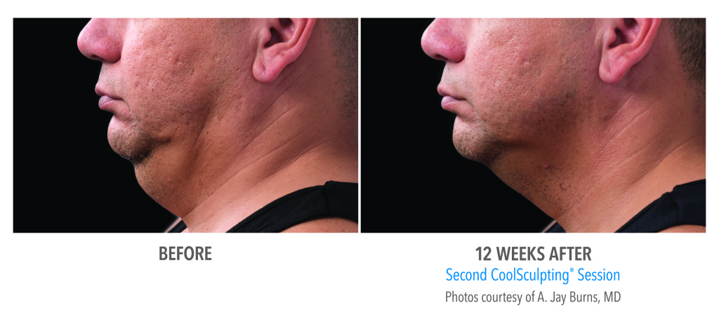 Male neck, before and 12 weeks after second CoolSculpting session, side view, patient 6