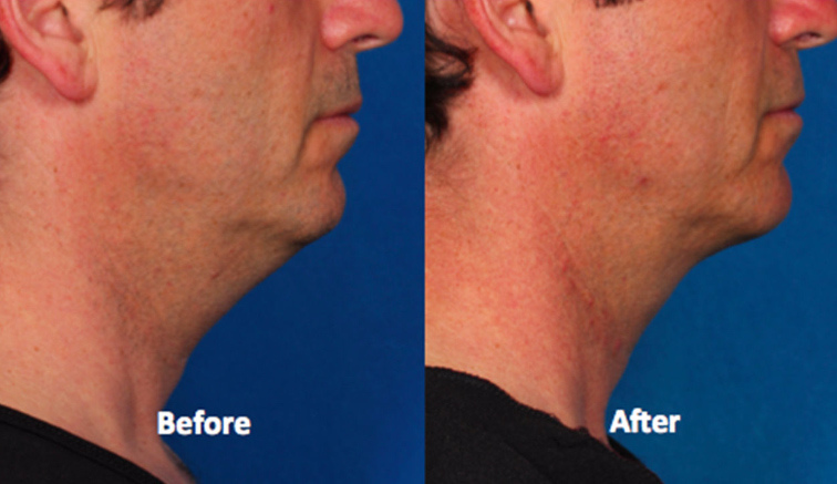 Male neck, before and after Kybella treatment, side view, patient 7