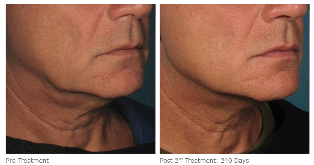 Male neck, before and 240 days after Ulthera treatment, side view, patient 3