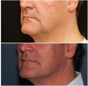 Male neck, before and after Thermage treatment, side view, patient 4