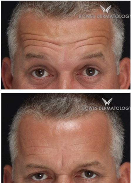 Male forehead, before and after wrinkle treatment, front view, patient 5