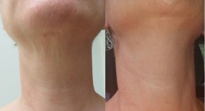 Female neck, before and after Collagen P.I.N. treatment, patient 3