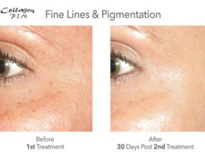 Female face (fine lines and pigmentation), before and after Collagen P.I.N. treatment, patient 2