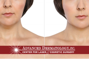 Kybella at Advanced Dermatology, PC