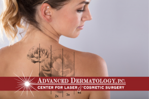 Dr. John Troccoli – Laser Tattoo Removal