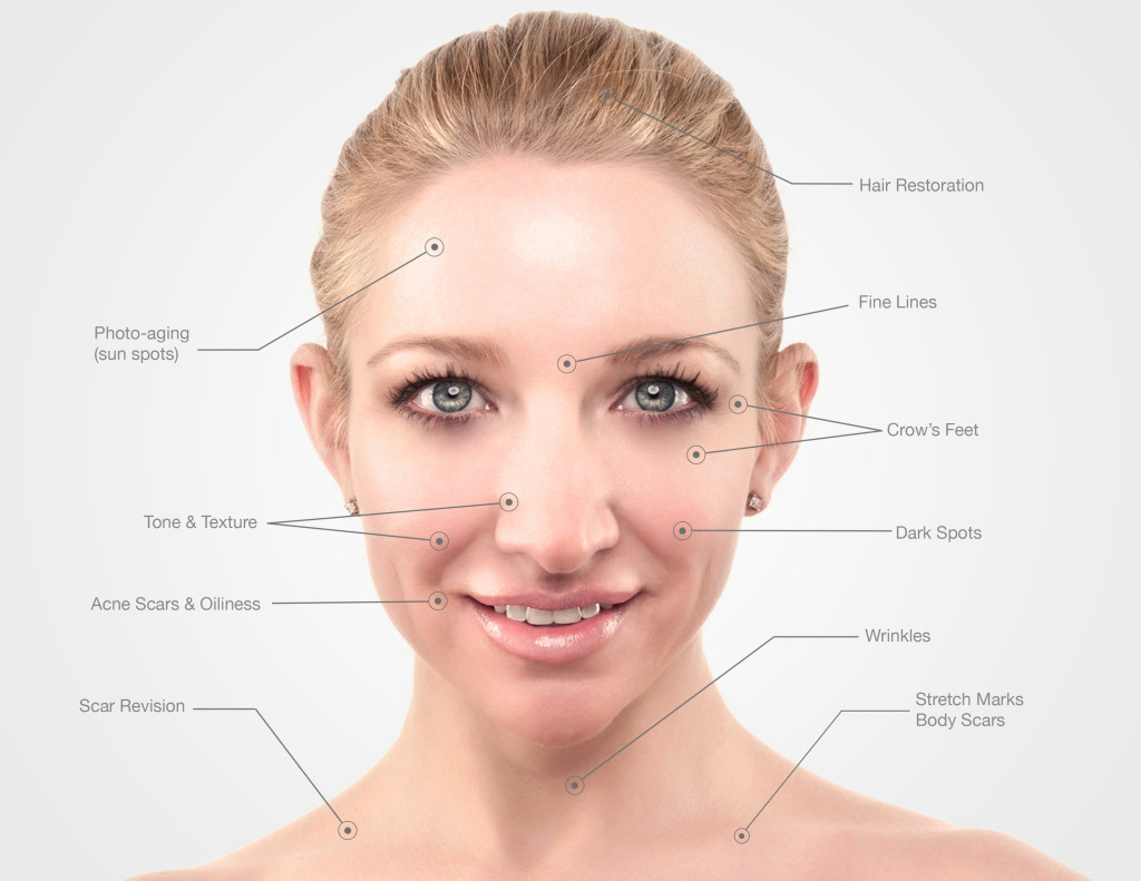 Female profile, collagen treatment zones