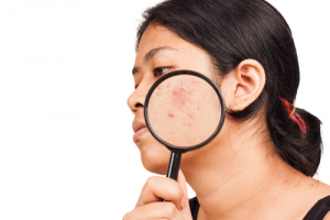 An Effective Solution to Acne?