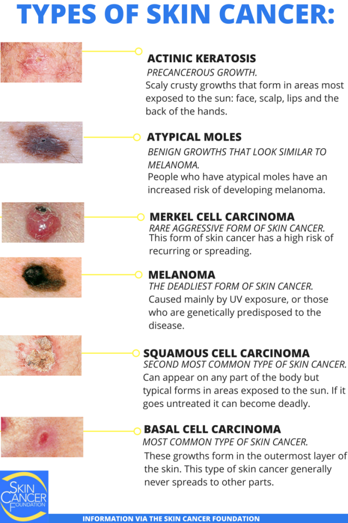 TYPES OF SKIN CANCER-