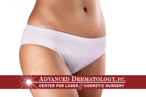 Dr. Fox Discusses Stretch Mark Treatement With Lasers