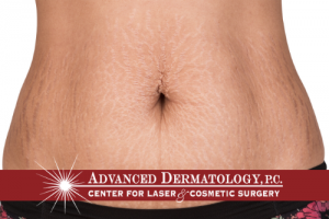 Dr. Fox Interviewed About Innovative Stretch Mark Treatment