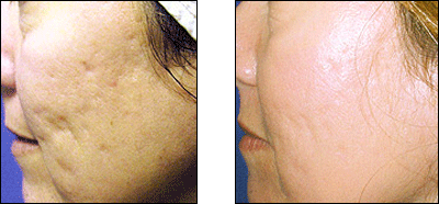 Fraxel Laser - Before and After