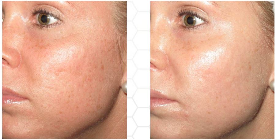 Female face, before and after Chemical Peels treatment, oblique view, patient 2