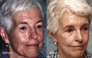 Female face, before and after Chemical Peels treatment, oblique view, patient 3
